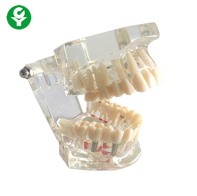 वयस्क पैथोलॉजी डेंटल शिक्षा मॉडल पारदर्शी रंग दांत संरक्षण